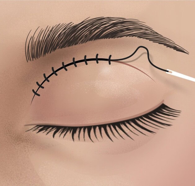 2. Schritt der Augenlidstraffung – sicher und risikoarm in Lustenau und Umgebung