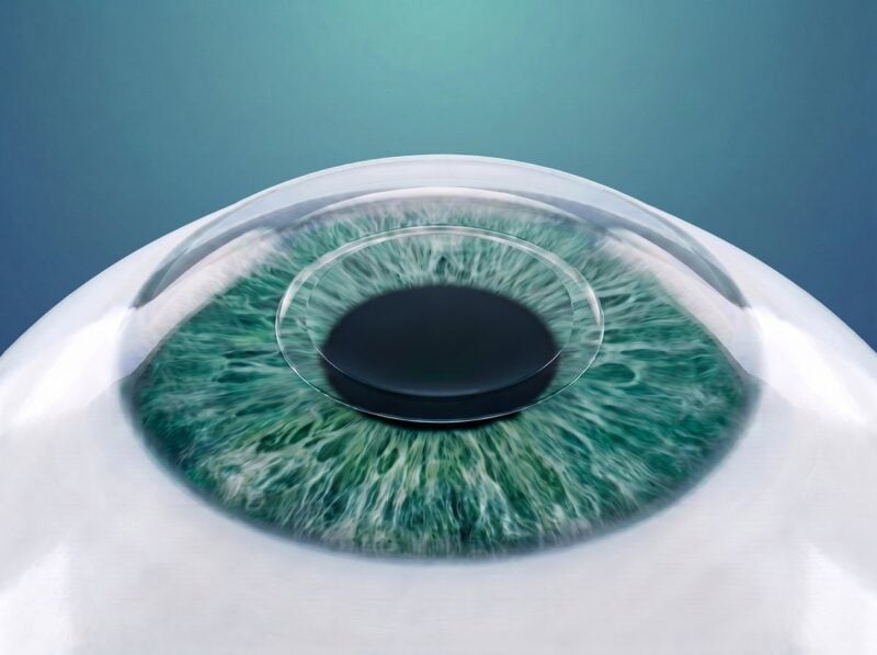Add-on-Linse: sicherer, unsichtbarer Sitz im Auge
